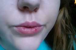 How to Get Rid of Chapped Lips