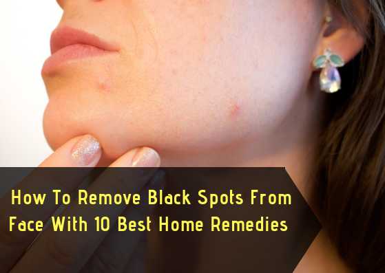 How To Remove Black Spots From Face With 10 Best Home Remedies - Lifestylica