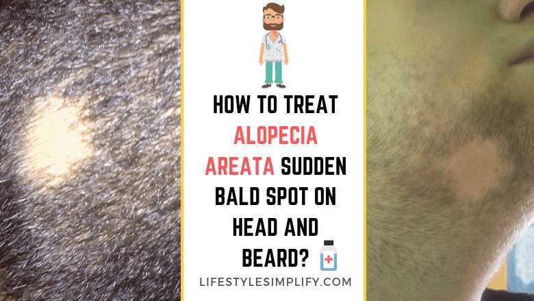 How To Treat Alopecia Areata Sudden Bald Spot On Head And Beard?