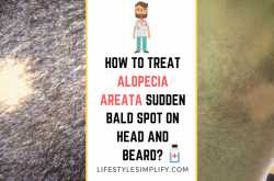 How to Treat Alopecia Areata Sudden Bald Spot on Head and Beard?