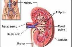 How to avoid kidney stones