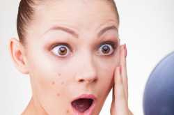 How to get Acne (Pimple\