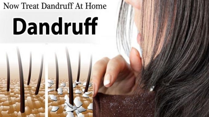 How To Get Rid Of Dandruff Permanently | Best 20 Tips For Dandruff Free Hair - The Real Mens Fashion