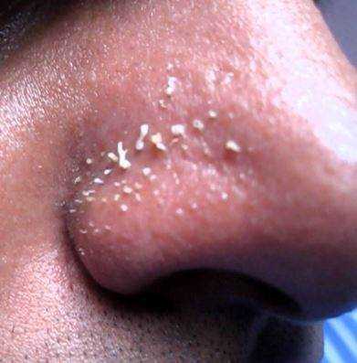 How To Get Rid Of Whiteheads On Nose- Women