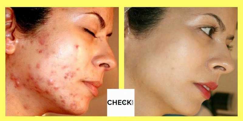 How To Get Rid Of Acne Scars Natural Home Remedies