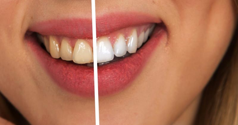 How To Whiten Your Teeth? | Health Tips