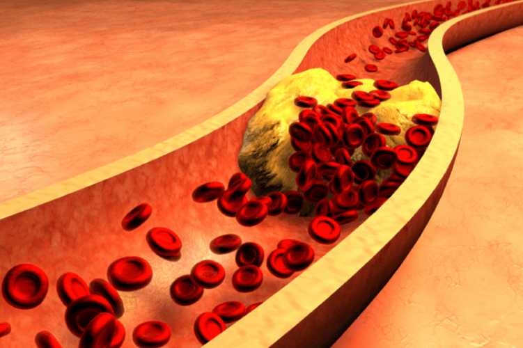 Hyperlipidemia : Remedies, Causes, Symptoms, Classification
