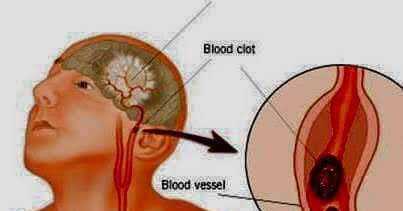 IMPORTANT-Telltale Signs Of A Stroke...