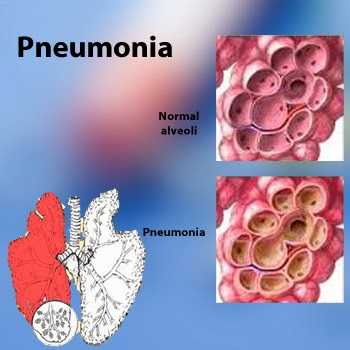 Increase The Knowledge Of Pneumonia And Their Drug With Best PPT Templates