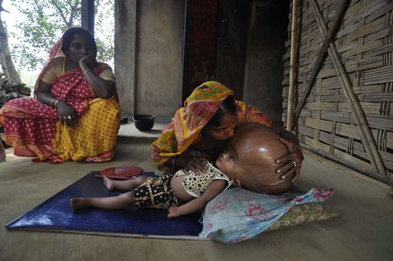 Indian Baby Roona Goes Home After  Five Surgeries For Big Head Syndrome Hydrocephalus