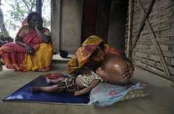 Indian Baby Roona goes home after  five surgeries for big head syndrome Hydrocephalus