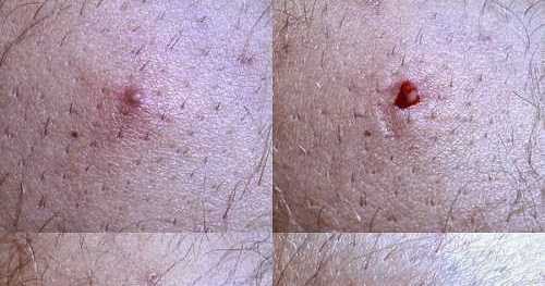 Ingrown Hair Causes - Ingrown Hair Symptoms
