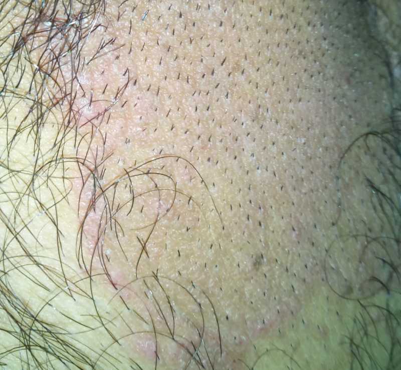 JOCK ITCH: Itching Over Groin(दाद ,खाज, खुजली) 