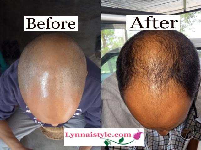 Jonk Oil Reviews: Can Jonk Oil Really Cure Baldness? | Lynnai Style