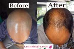 Jonk oil reviews: Can Jonk oil really cure baldness? | Lynnai Style