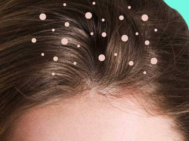 KNOW ABOUT HOW TO TREAT DANDRUFF IN COLORED HAIRS