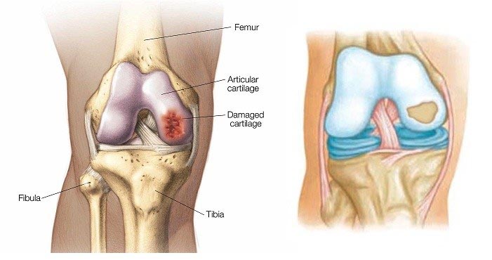 Knee Cartilage Regeneration Home Remedies And Treatment (Must Read)