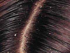 Know How To Make Anti-dandruff Preparations At Home | DailyHealthNeeds.com