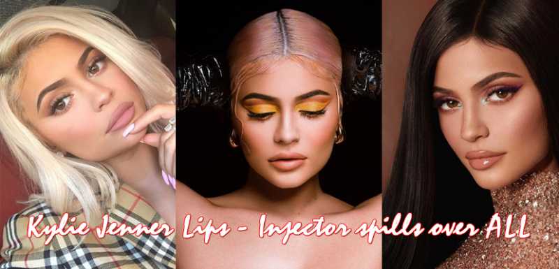 Kylie Jenner Lips - Injector Spills Over ALL | Urban Mira