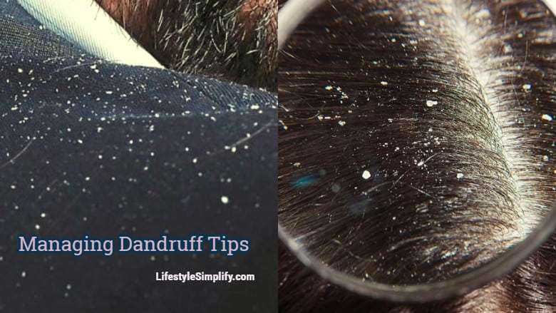 Managing Dandruff - How To Treat Those Flakes