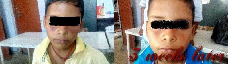 Melasma In Child Homeopathic Treatment