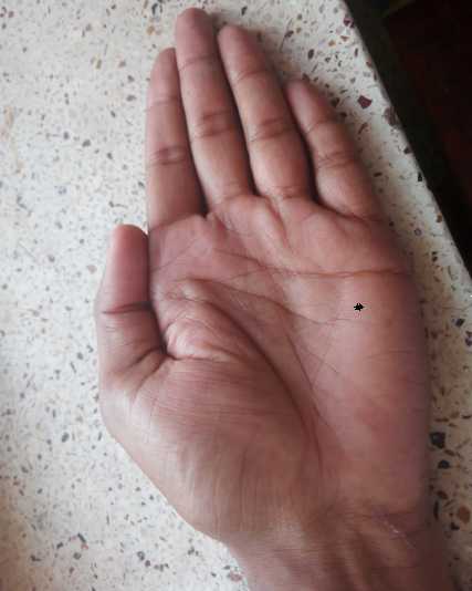 Mole (Til) On The Palm And Mounts 