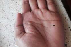 Mole (Til) on the Palm and Mounts 