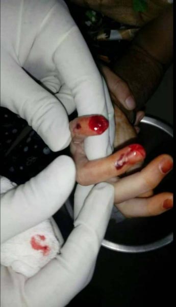 Mumbai: Father File FIR Against School After 5-year-old Daughter Loses Finger - KUNDAN SRIVASTAVA