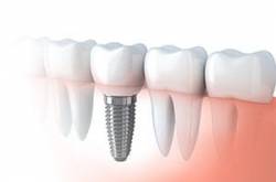 My First Dental Implant in Vizag Review - SriramRaj Blog