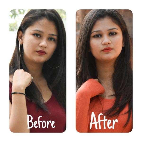 My Experience With Microdermabrasion At Metamorphosis Clinic