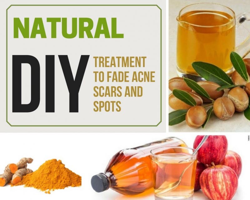 Natural DIY Treatment To Fade Acne Scars And Spots - Makeup And Body Blog