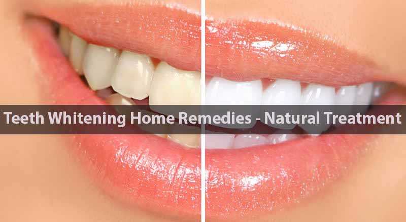 Natural Teeth Whitening Home Remedies -