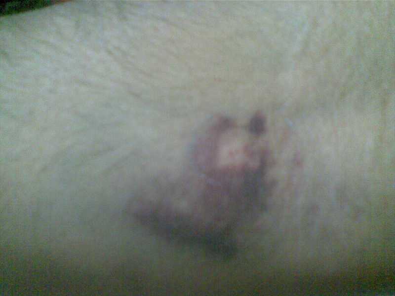 Negligence At The Blood Bank