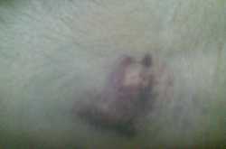 Negligence at the Blood Bank