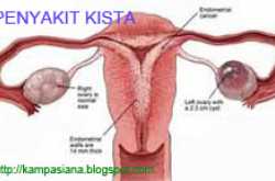 OBAT (JAMU) KISTA ALAMI (TRADISIONAL)