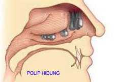 OBAT (JAMU) POLIP ALAMI (TRADISIONAL)