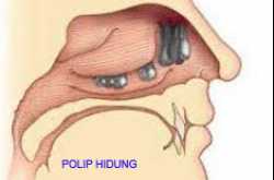 OBAT (JAMU) POLIP ALAMI (TRADISIONAL)