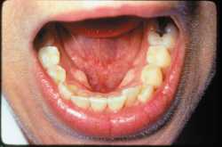 Oral Cancer Causes & How to Prevent Oral Cancer #PreventableCancer - HealthVeda