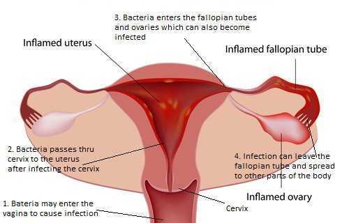 PID - Treat Pelvic Inflammatory Disease Naturally - Home Remedies Box