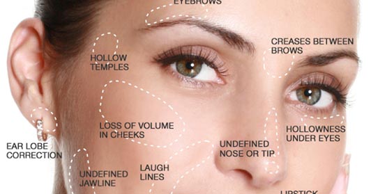 PRP 's Dermal Filler Cousin - PRFM