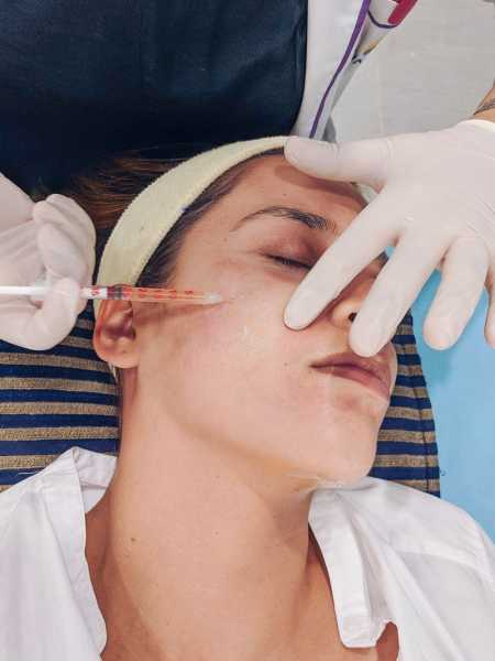 PRP Treatment Or Vampire Facial Experience