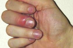 Paronychia symptoms - Paronychia treatment