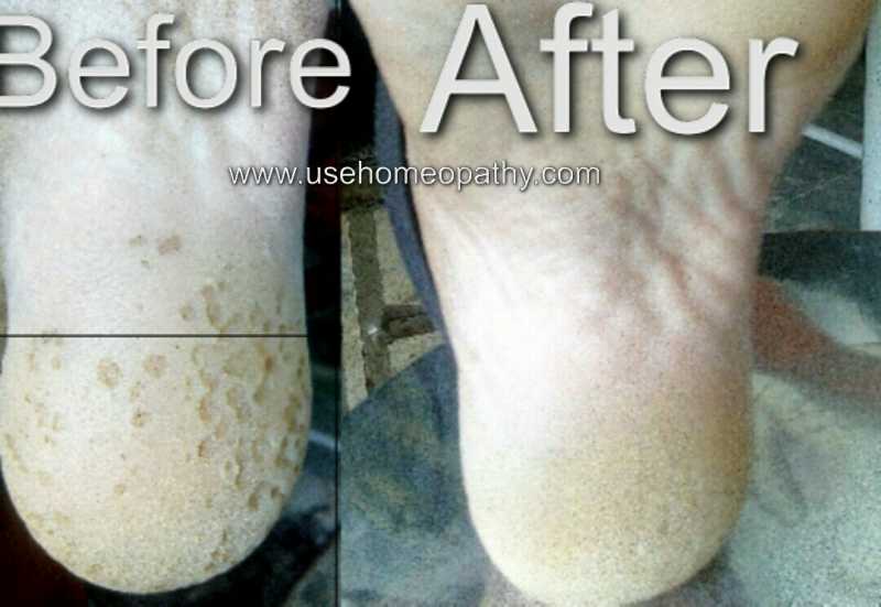 Pitted Keratolysis Homeopathic Treatment