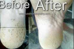 Pitted Keratolysis Homeopathic Treatment