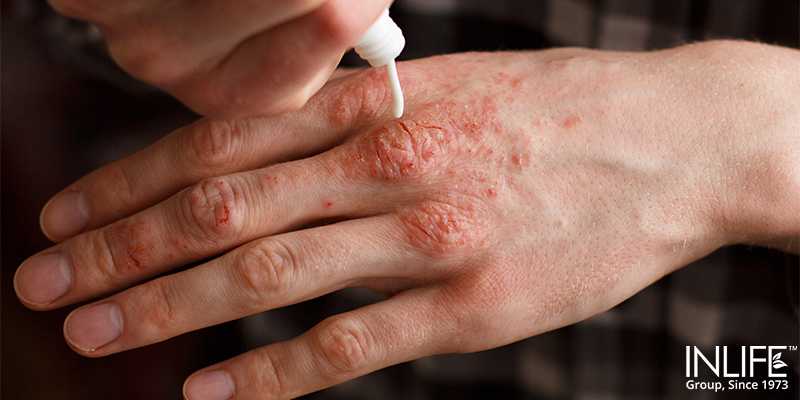 Psoriasis And Mental Health - InlifeHealthCare