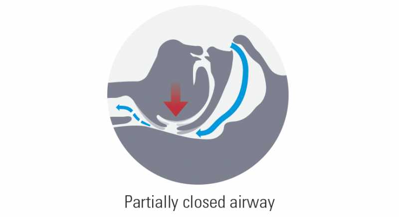 Reasons For Snoring And First Step To Resolve