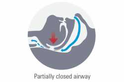 Reasons for snoring and first step to resolve