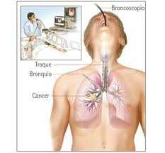 Remove Fluids From Lungs