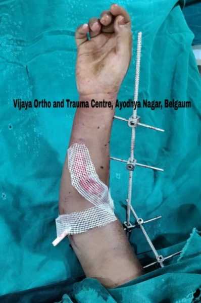 Replantation Of Amputated Limb On Five Year Old - All About Belgaum