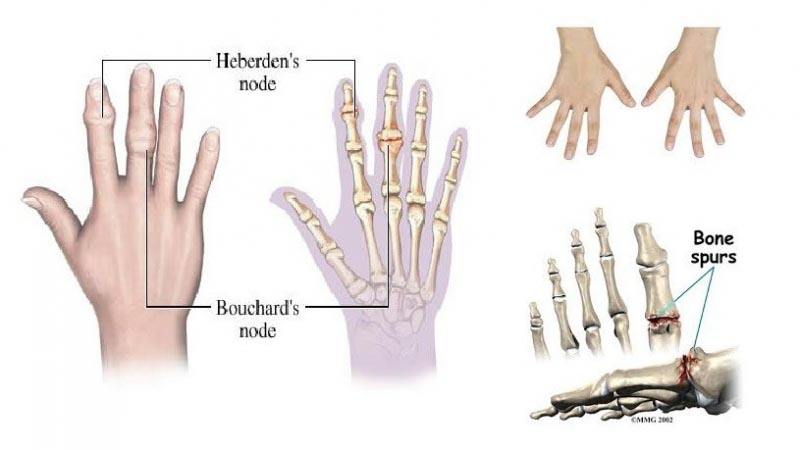 Risks And Treatments Of Bone Spur In Finger - Doctor Curex